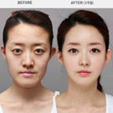 รวมภาพ Before&After ศัลยกรรมเกาหลี