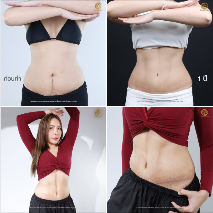Tummy tuck Sexy S