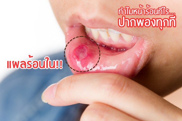 ร้อนใน แผ่นแปะ วิธีแก้ร้อนใน  แก้ร้อนใน ยาทาแก้ร้อนใน