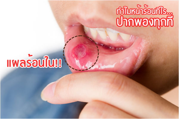 แผลร้อนในที่ลิ้นและกระพุ้งแก้ม: รวมสาเหตุและวิธีรักษาให้หายขาดในช่วงหน้าร้อน