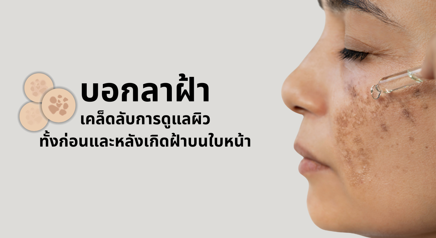 ส่องกระจกเช็กด่วน! เรื่อง "ฝ้า" ที่ผู้หญิงทุกคนต้องรู้