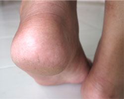 รีวิว พอลก้า แคร็ก ฮีล ครีม (Polka Cracked Heel Cream)