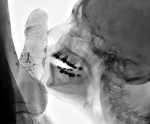 X-Ray เอ็กซ์